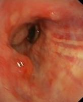 Small cell carcinoma