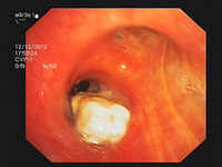 Endobronchial lymphoma of the truncus intermedius