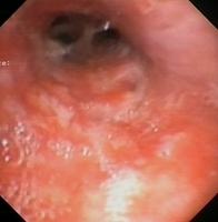 Thyroid carcinoma