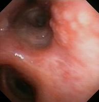 Metastatic thyroid carcinoma