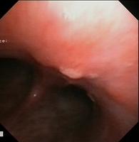 Metastatic thyroid carcinoma