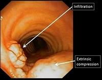 Oesophageal cancer