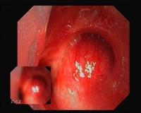 Adenocystic carcinoma