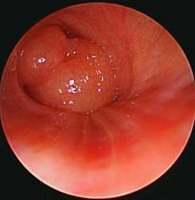 Chondrohamartoma of the left upper lobe bronchus