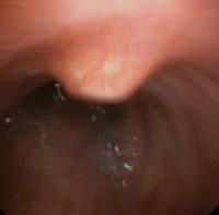 Chondrosarcoma of the trachea