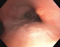 Endobronchial tuberculosis