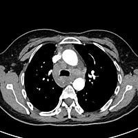 Lymphadenopathy, TB