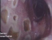 Mucosal ulcers in a patient with HSV1, H1N1 and aspergillus infection