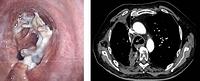 Actinomycosis