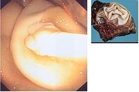 Hydatid cyst (pulmonary echinococcosis)