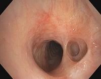 Diverticulum