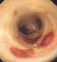 HIV-associated endobronchial lesions