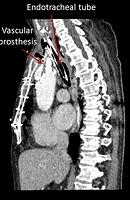 Tracheo-mediastinal fistula (CT scan)