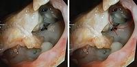 Tracheo-mediastinal fistula