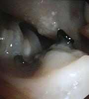 Tracheo-mediastinal fistula