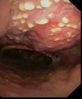 Oral candidiasis