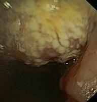 Oral candidiasis (Thrush)