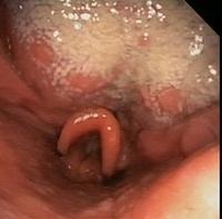 Oral candidiasis (Thrush)