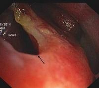 Perforation of the nasal septum