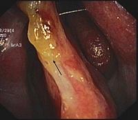 Perforation of the nasal septum