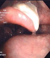 Pill impacted on the epiglottis