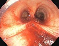 Iatrogenic lesions