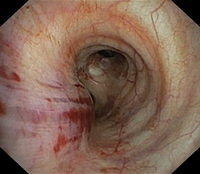 Non-iatrogenic lesions