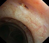 Mucosal tear