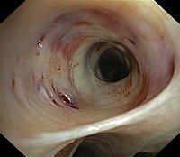 Mucosal tears and ecchymoses